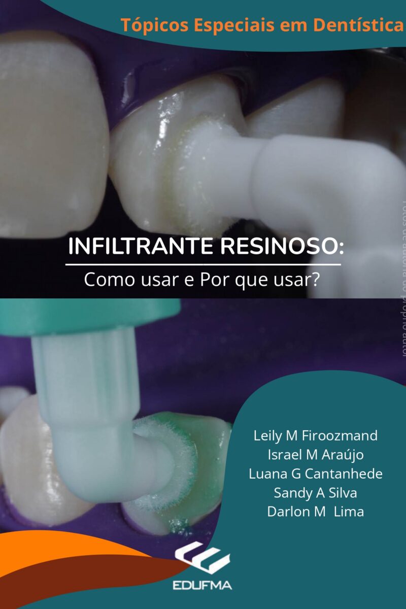 Infiltrante Resinoso : como usar e por que usar?